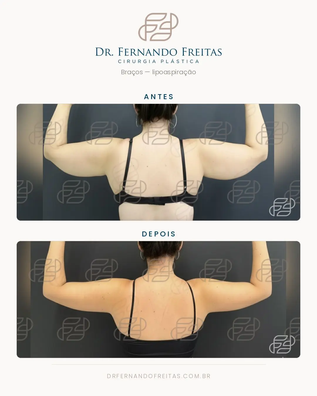 Braços antes e depois da lipoaspiração de lipedema, vista de costas