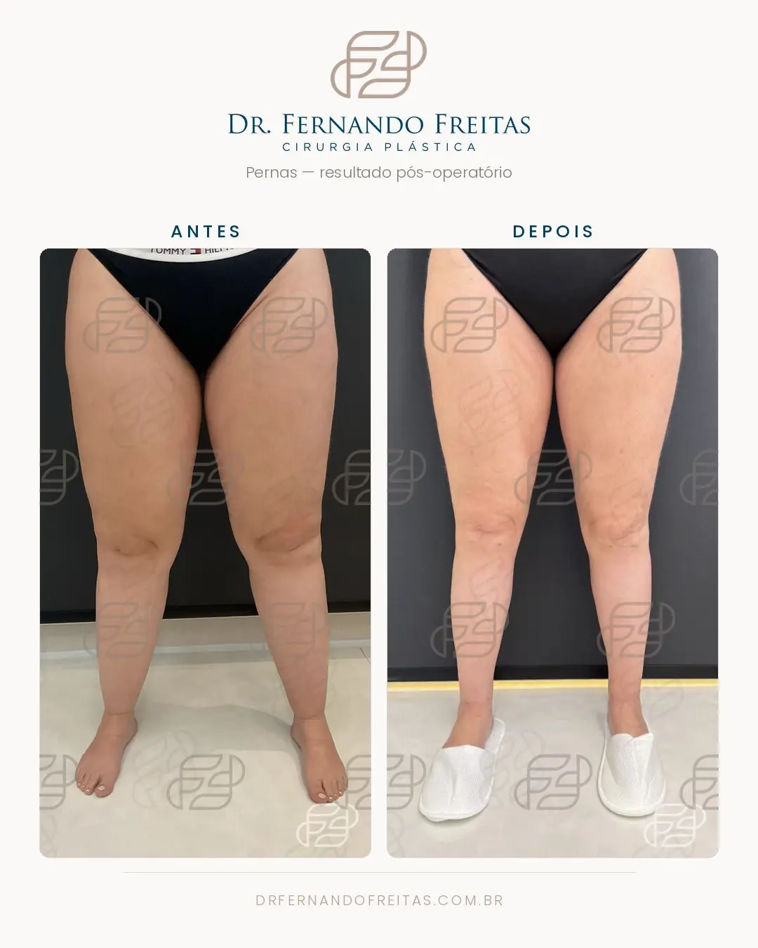 Pernas antes da cirurgia de lipedema e no resultado pós-operatório, vista frontal