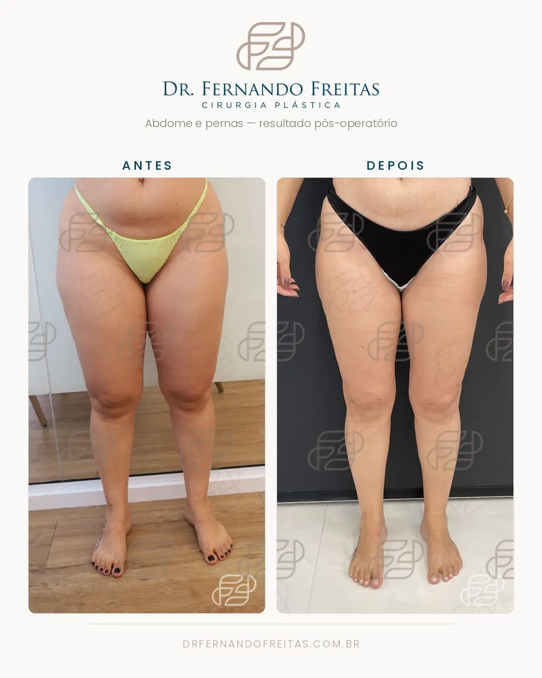 Abdome e pernas antes da cirurgia de lipedema e no resultado pós-operatório, vista frontal