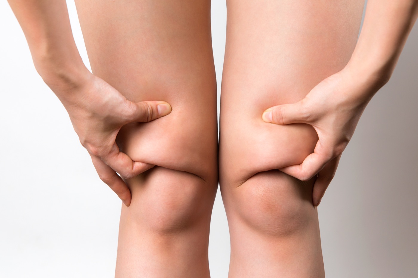 Teste de beliscar mostrando o acúmulo de gordura desproporcional nas pernas, característico do lipedema
